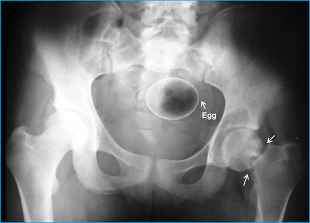 X Rays That Prove People Will Shove Pretty Much Anything Up Their Butts