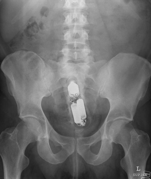 X Rays That Prove People Will Shove Pretty Much Anything Up Their Butts
